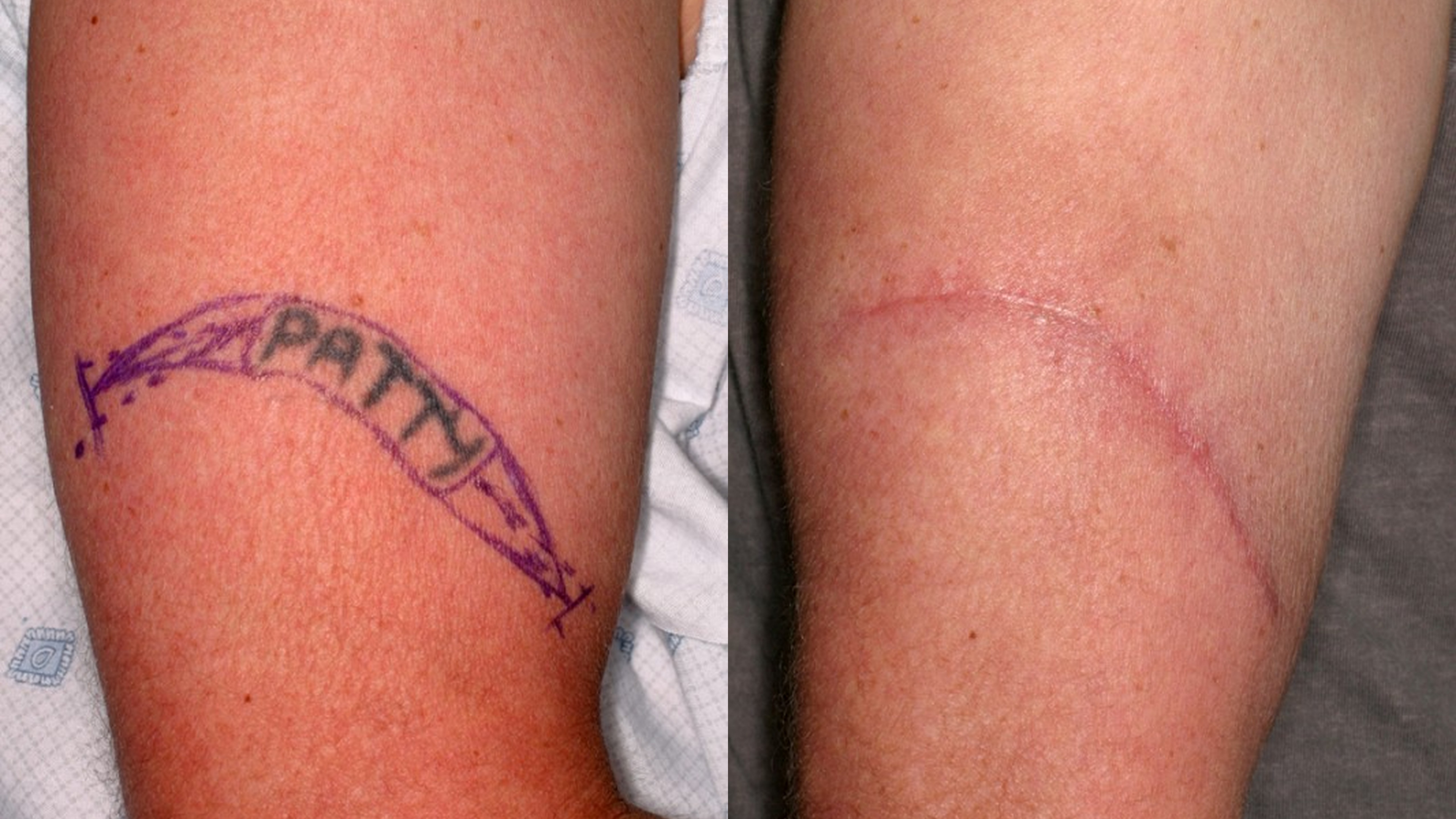 LASER Tattoo Removal, Tattoo Surgery and other methods: All you need ...