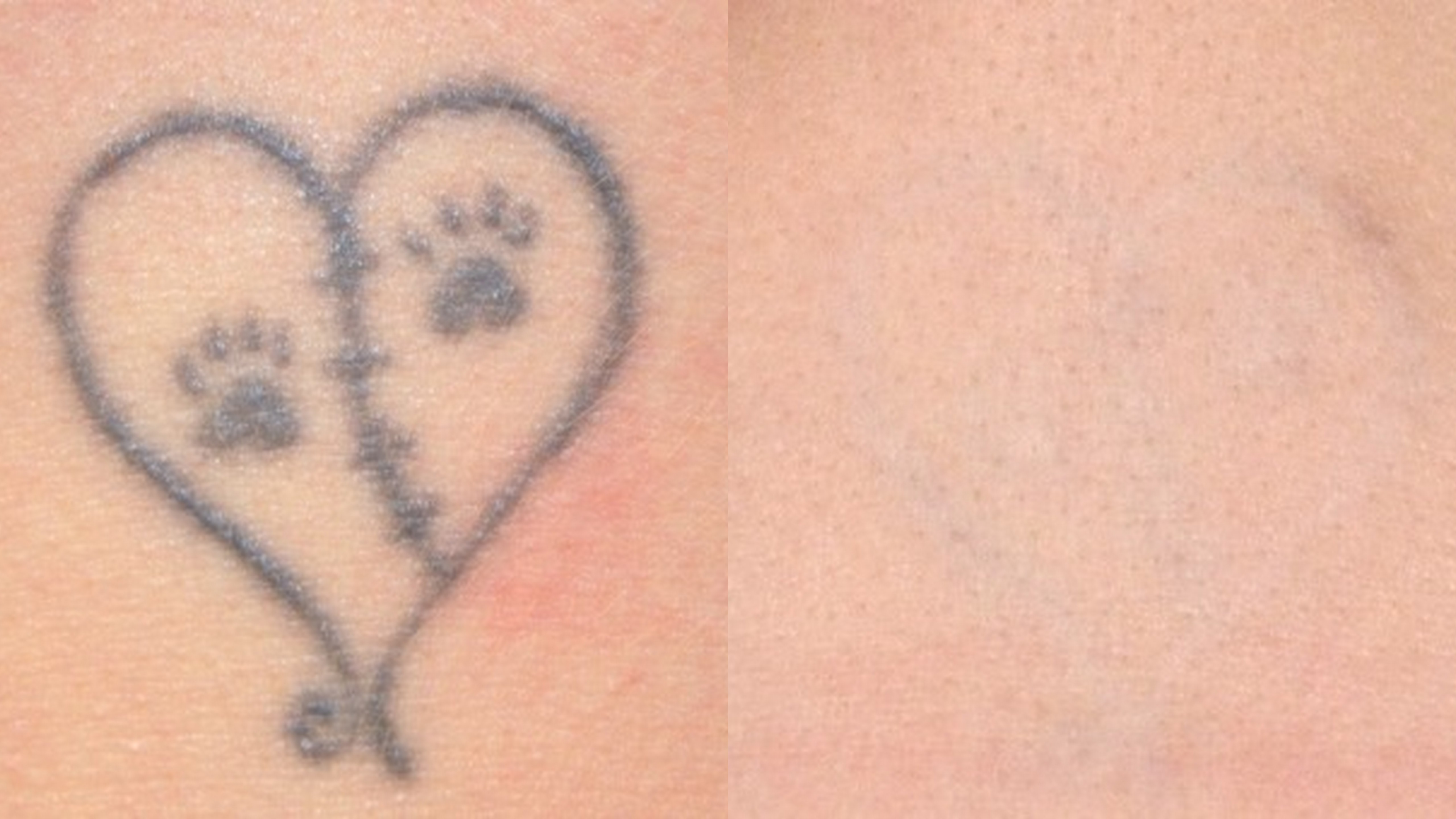 Tattoo Removal - PSRx Body and Skin