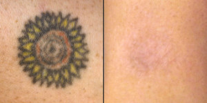 Tattoo Removal LASER Visakhapatnam