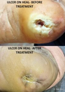 Leg Ulcer