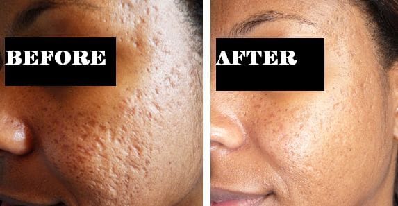 Dermaroller Treatment in Visakhapatnam