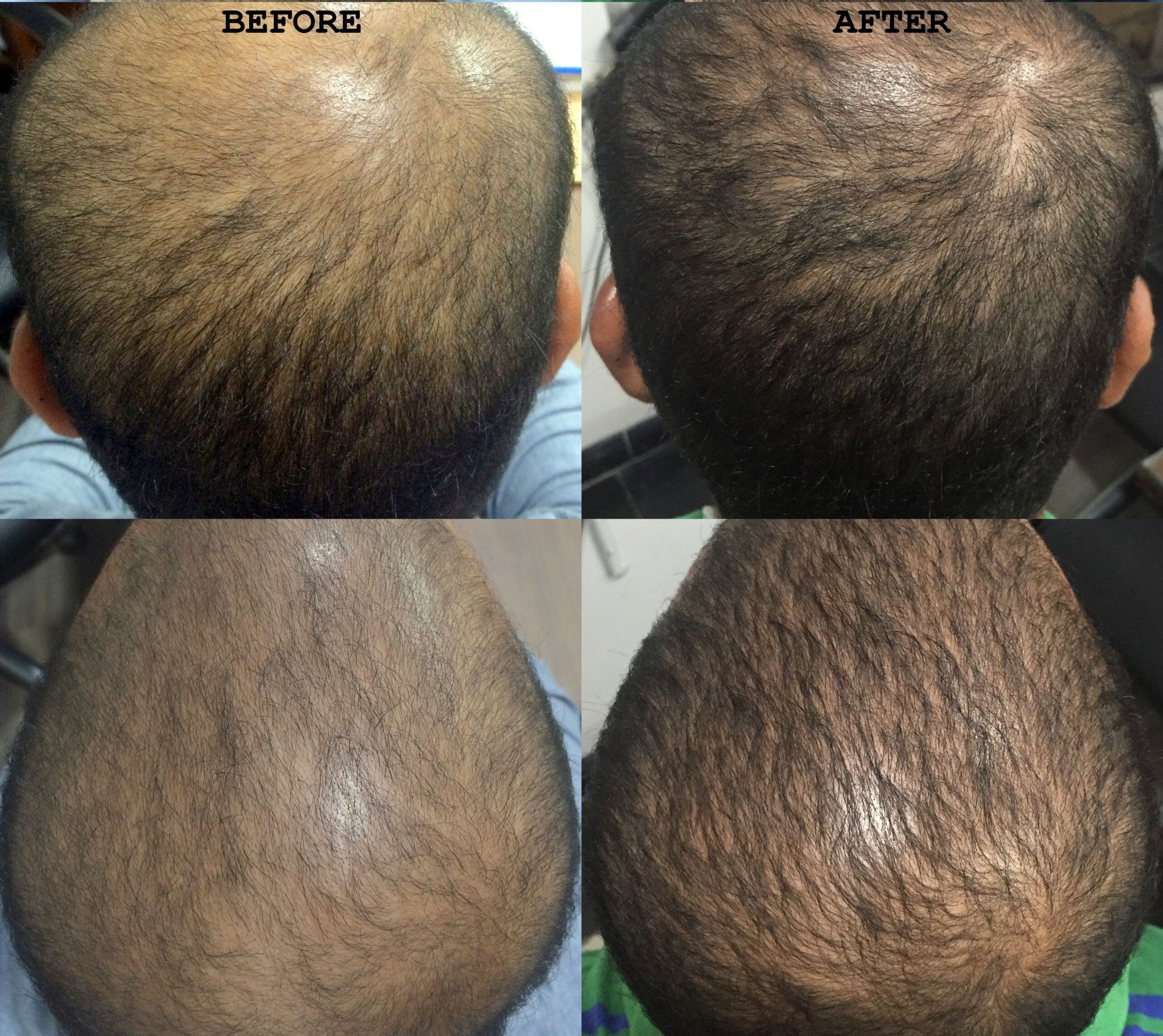 Treatment for Hair Loss Treatment in Visakhapatnam