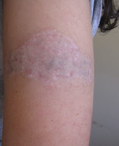 LASER Tattoo Removal, Tattoo Surgery and other methods: All you need to Know Treatment in Visakhapatnam