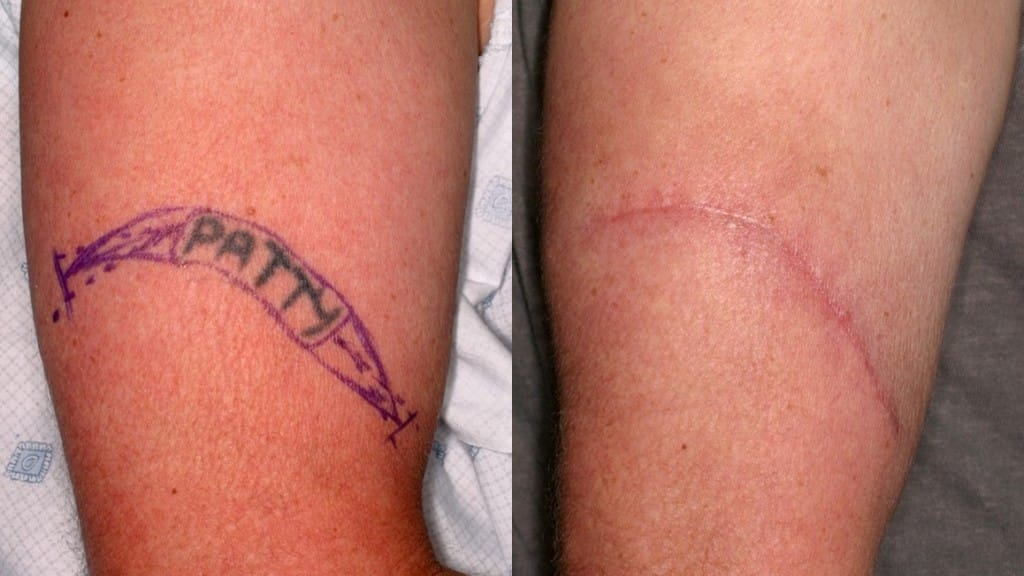 LASER Tattoo Removal, Tattoo Surgery and other methods: All you need to Know Treatment in Visakhapatnam