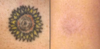 LASER Tattoo Removal, Tattoo Surgery and other methods: All you need to Know Treatment in Visakhapatnam