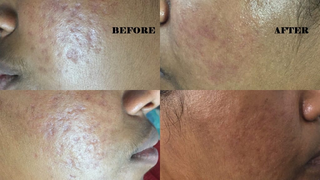 Dermaroller Treatment in Visakhapatnam