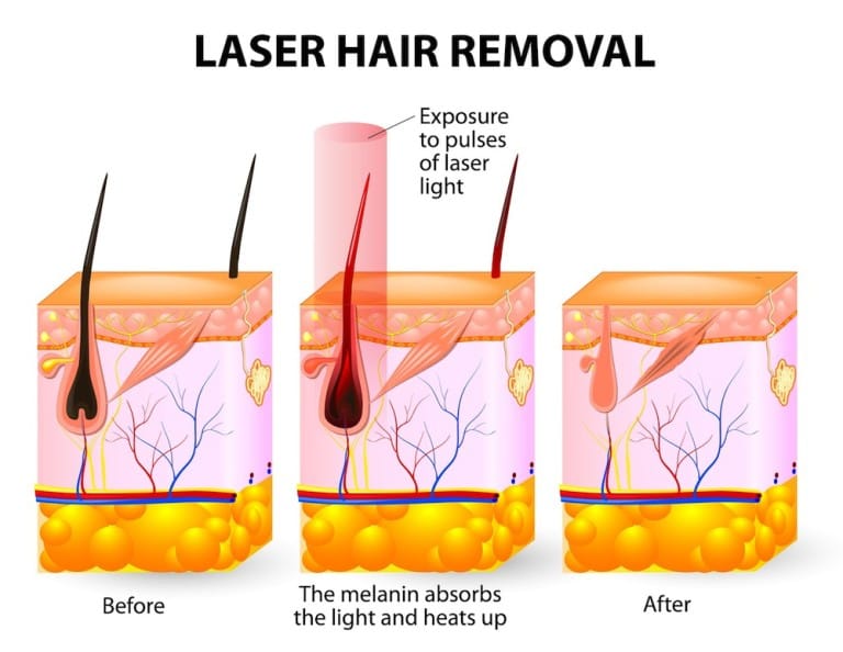 Laser Hair Removal Treatment in Visakhapatnam
